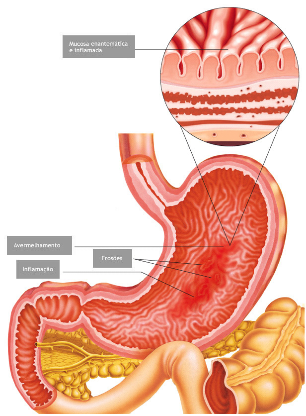 Gastrite O Que é e quais os sintomas Somos Popular Saúde