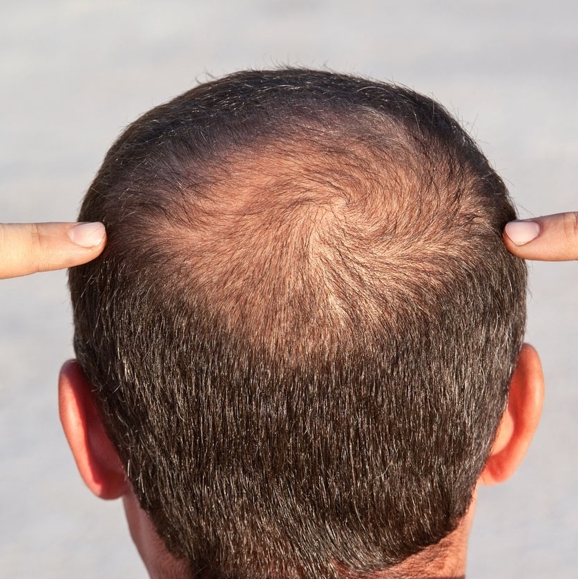 O que é Minoxidil e para que serve Tratamento Queda de Cabelo