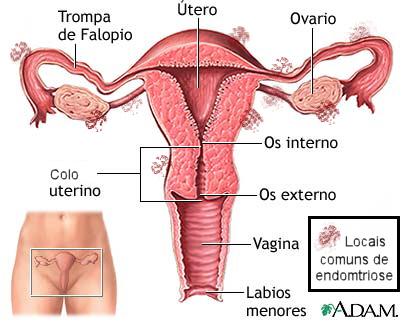 O Que a Endometriose Pode Causar?..