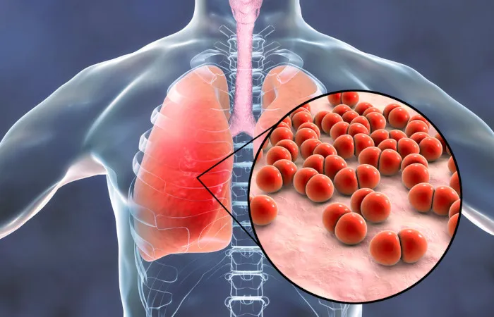 Pneumonia- O Que é, Sintomas e Tratamento..