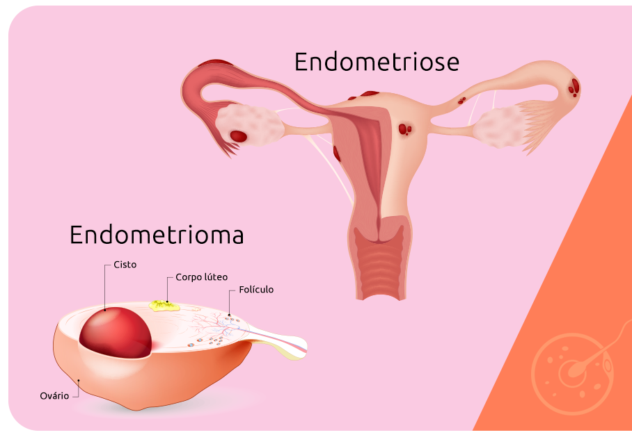 O Que é Endometrioma?