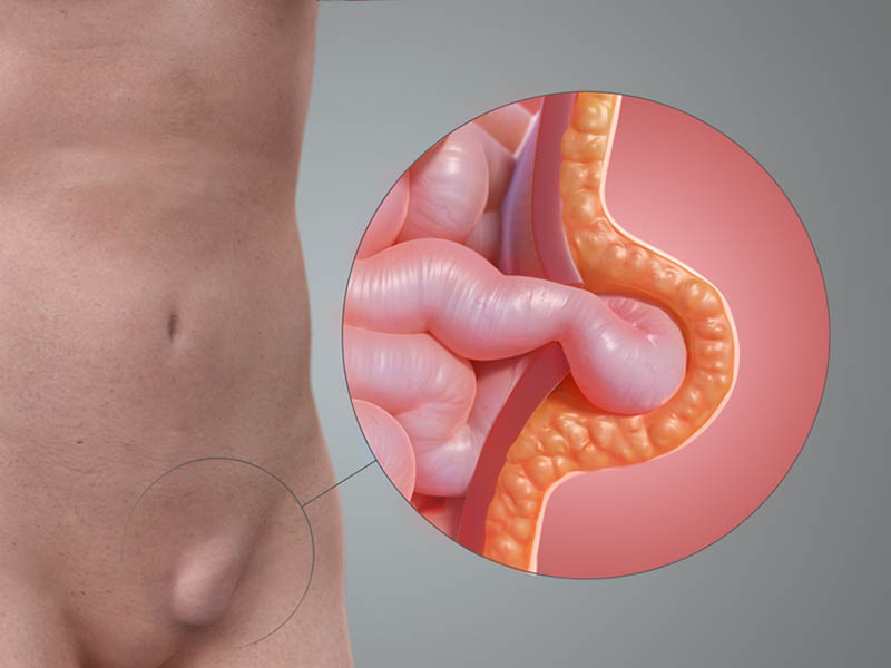 Herniorrafia Inguinal- O Que é e Como é Feita.