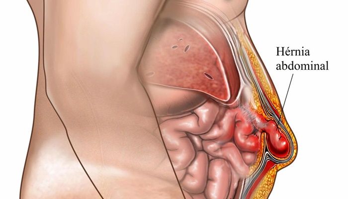Hérnia Abdominal- O Que é, Causas e Tratamento.