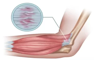 O Que é Epicondilite Medial?.